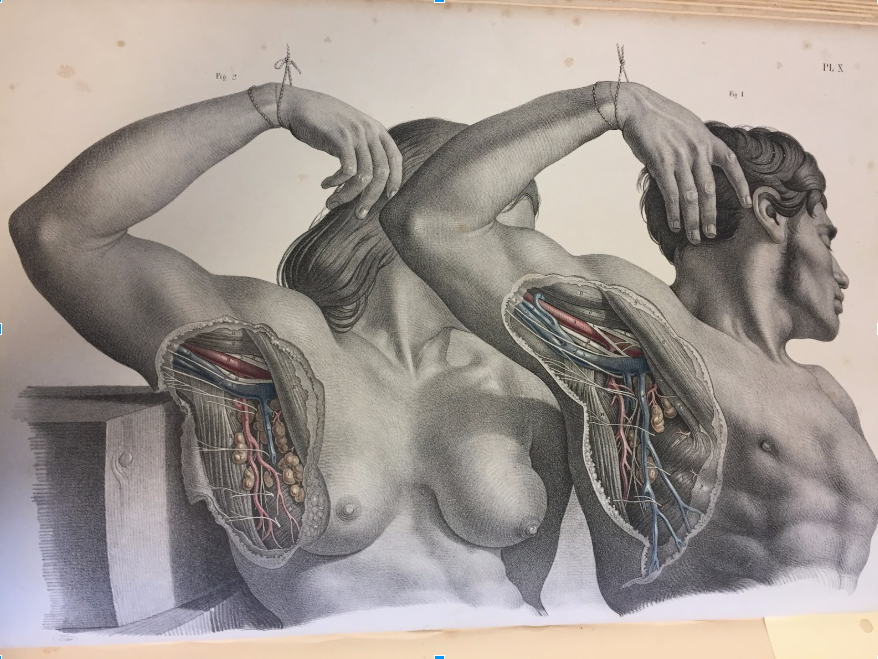 Male and Female lymph node dissection from Surgical Anatomy by Joseph Maclise (1851).