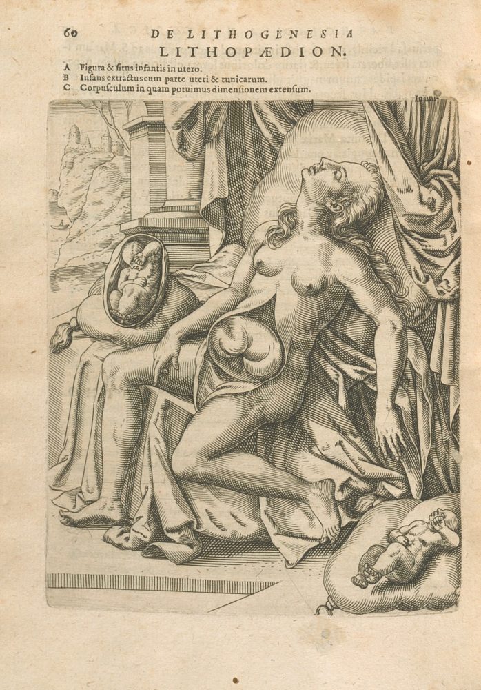 Schenck, Johann Georg. Lithogenesia ; sive, De microcosmi membris petrefactis Francofurti, 1608. Courtesy of the Wangensteen Historical Library